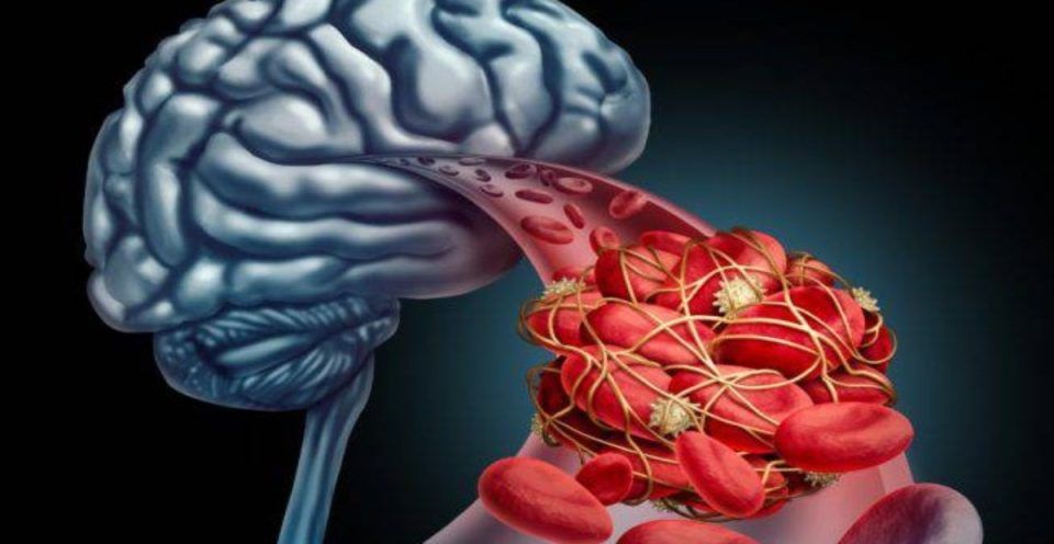 453360 anevrysma egkefalou ti einai kai poia proima simadia den prepei na agnoisete.jpg