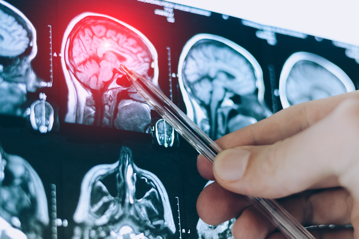 454753 anevrysma egkefalou ta sybtomata pou proeidopoioun oti einai sovaro.jpg