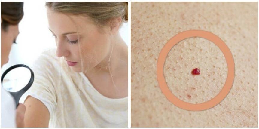 454824 kokkines elies sto derma giati emfanizontai kai ti prepei na gnorizete pote einai ath69e36bf6088e1.jpg