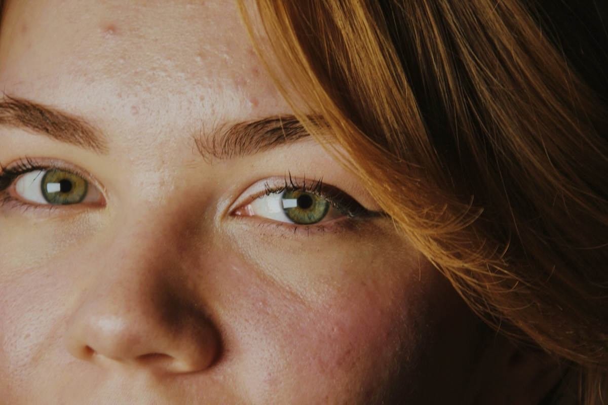 455301 lipos sto sykoti ta siopila simadia pou borei na emfanistoun sto prosopo sas.jpg